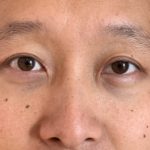 Asiatiska ögon före efter