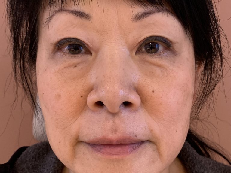 Efter Asiatiska ögon före efter