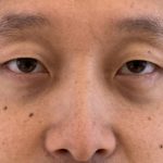 Asiatiska ögon före efter