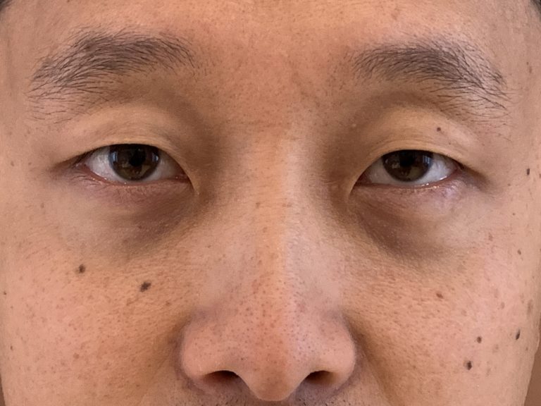 Före Asiatiska ögon före efter