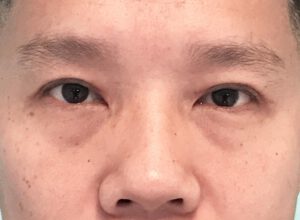 Dubbelt ögonlocksveck (mono eyelid) före och efter (efter)
