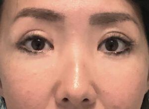 Dubbelt ögonlocksveck (mono eyelid) före och efter (efter)