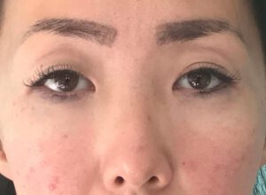 Dubbelt ögonlocksveck (mono eyelid) före och efter (före)