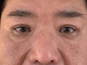 Dubbelt ögonlocksveck (mono eyelid) före och efter (efter)