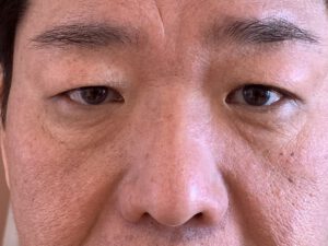 Dubbelt ögonlocksveck (mono eyelid) före och efter (före)