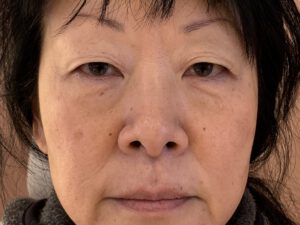 Dubbelt ögonlocksveck (mono eyelid) före och efter (före)