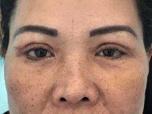 Dubbelt ögonlocksveck (mono eyelid) före och efter (efter)