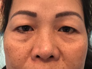 Dubbelt ögonlocksveck (mono eyelid) före och efter (före)