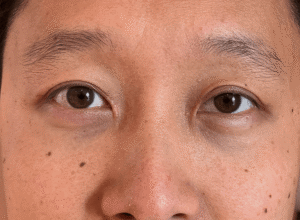 Dubbelt ögonlocksveck (mono eyelid) före och efter (efter)