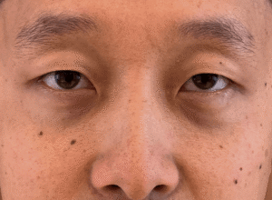Dubbelt ögonlocksveck (mono eyelid) före och efter (före)
