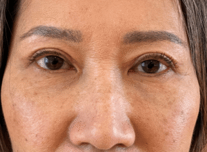 Dubbelt ögonlocksveck (mono eyelid) före och efter (efter)