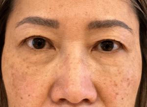 Dubbelt ögonlocksveck (mono eyelid) före och efter (före)