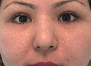 Dubbelt ögonlocksveck (mono eyelid) före och efter (efter)
