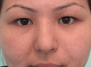 Dubbelt ögonlocksveck (mono eyelid) före och efter (före)