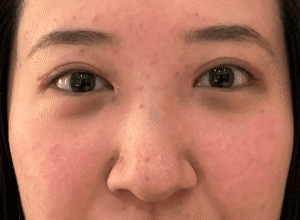 Dubbelt ögonlocksveck (mono eyelid) före och efter (efter)