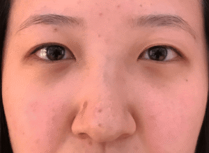 Dubbelt ögonlocksveck (mono eyelid) före och efter (före)