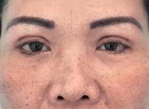 Dubbelt ögonlocksveck (mono eyelid) före och efter (efter)