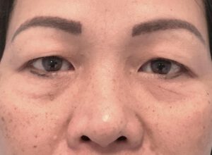 Dubbelt ögonlocksveck (mono eyelid) före och efter (före)