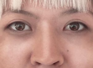 Dubbelt ögonlocksveck (mono eyelid) före och efter (efter)