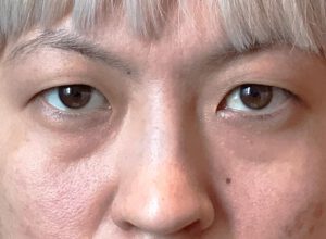 Dubbelt ögonlocksveck (mono eyelid) före och efter (före)