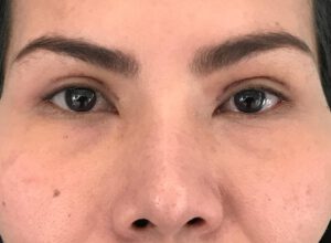 Dubbelt ögonlocksveck (mono eyelid) före och efter (efter)