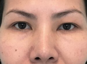 Dubbelt ögonlocksveck (mono eyelid) före och efter (före)