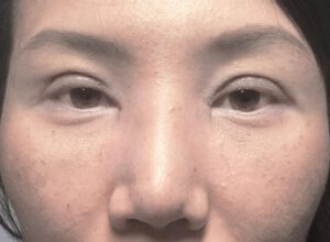 Dubbelt ögonlocksveck (mono eyelid) före och efter (efter)