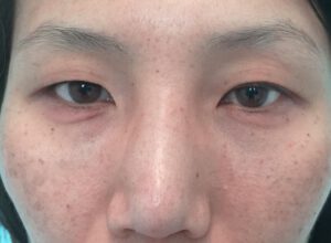 Dubbelt ögonlocksveck (mono eyelid) före och efter (före)