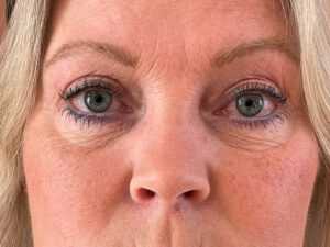 Ögonlocksplastik före och efter – övre och nedre ögonlock (efter)