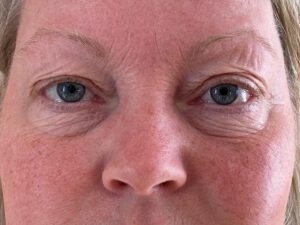 Ögonlocksplastik före och efter – övre och nedre ögonlock (före)