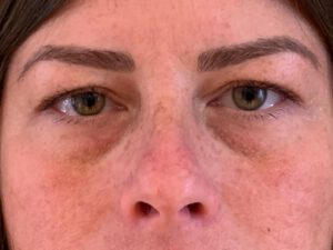 Ögonlocksplastik före och efter – övre och nedre ögonlock (före)