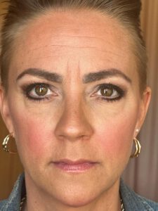 Ögonlocksplastik före och efter – övre och nedre ögonlock (efter)