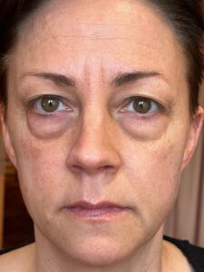 Ögonlocksplastik före och efter – övre och nedre ögonlock (före)