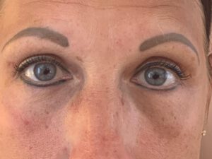 Ögonlocksplastik före och efter – övre och nedre ögonlock (efter)