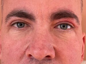 Ögonlocksplastik före och efter – övre och nedre ögonlock (efter)