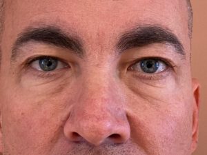 Ögonlocksplastik före och efter – övre och nedre ögonlock (före)