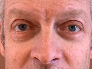 Ögonlocksplastik före och efter – övre och nedre ögonlock (efter)