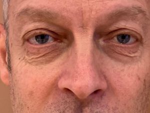 Ögonlocksplastik före och efter – övre och nedre ögonlock (före)