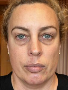 Ögonlocksplastik före och efter – övre och nedre ögonlock (före)