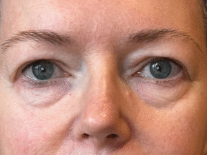 Ögonlocksplastik före och efter – övre och nedre ögonlock (före)