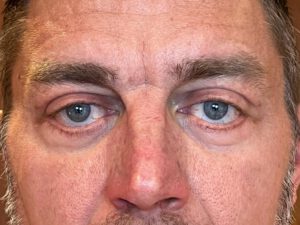 Ögonlocksplastik före och efter – övre och nedre ögonlock (efter)