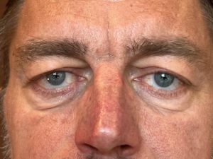 Ögonlocksplastik före och efter – övre och nedre ögonlock (före)