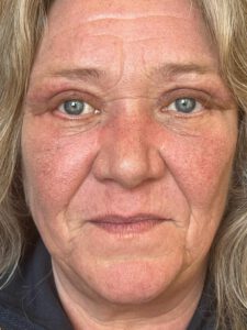 Ögonlocksplastik före och efter – övre och nedre ögonlock (efter)