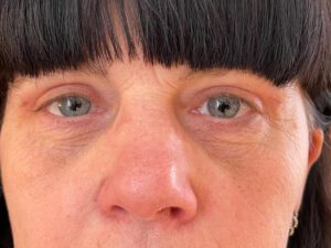 Ögonlocksplastik före och efter – övre och nedre ögonlock (efter)