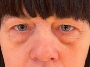 Ögonlocksplastik före och efter – övre och nedre ögonlock (före)