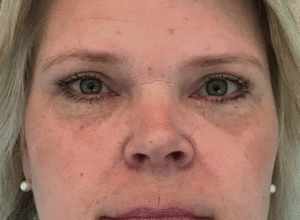 Ögonlocksplastik före och efter – övre och nedre ögonlock (efter)