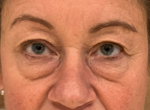 Ögonlocksplastik före och efter – övre och nedre ögonlock (före)