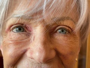 Ögonlocksplastik före och efter – övre och nedre ögonlock (efter)