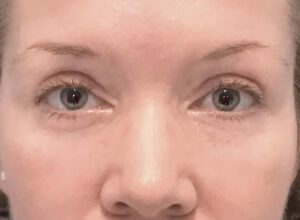 Ögonlocksplastik före och efter – övre och nedre ögonlock (efter)