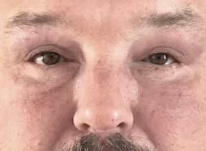 Ögonlocksplastik före och efter – övre och nedre ögonlock (efter)